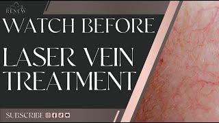 What To Expect - Excel V Laser Vein Treatment  Instantly Remove Spider Veins