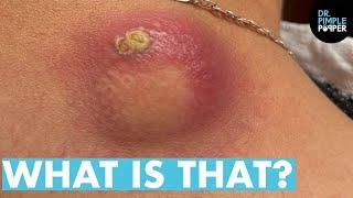 WHAT IS THAT Dr Lee Pops Satisfying Back Cyst  Dr Pimple Popper Reacts