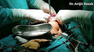 Removal of Ovarian Cyst by Umbilical Port by Dr.Avijit Basak