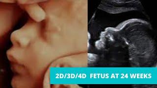 2D3D 4D Ultrasound at 24 weeks pregnancy video