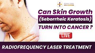 Seborrheic Keratosis Radiofrequency Laser Treatment  Can Skin Growth Turn into Cancer? Skin Lesions