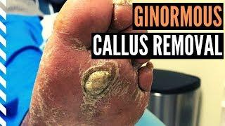 Ginormous Callus Removal