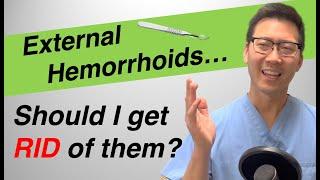 External hemorrhoid treatment Should I REMOVE or LEAVE them?