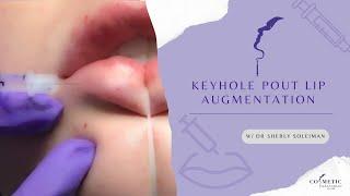 Keyhole Pout Lip Augmentation