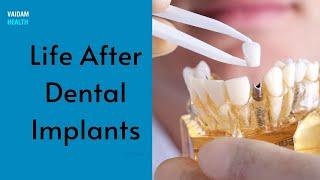 Life After Dental Implants