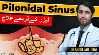 Pilonidal Sinus Surgery  What is Pilonidal Sinus in Urdu  Latest Treatment Pilonidal Laser Surgery