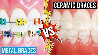 Clear Braces Vs. Metal Braces... What Type Works Best?