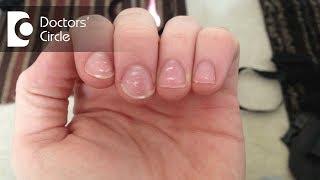 What causes white spots on nails and how to manage them? - Dr. Amee Daxini