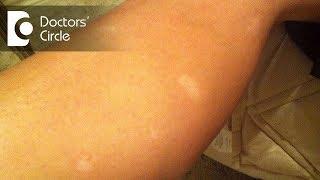 What causes sudden appearance of white round spots on legs? - Dr. Sudheendra Udbalker