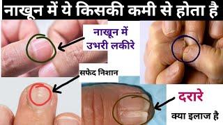 नाखून देखकर बीमारी का कारण जाने - Nail Examination