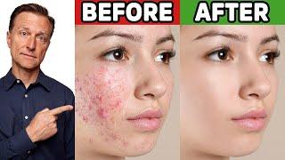 The Best Trick for Clear Skin Acne Aging Wrinkles Liver Spots