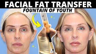 BIGGEST Facial Fat Transfer Myths