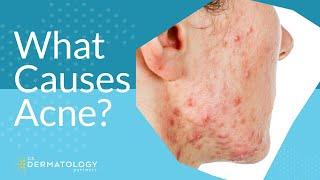 What Causes Acne?  Explained by Dermatologist