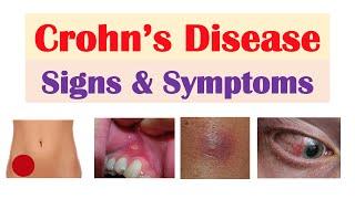 Crohn’s Disease Signs and Symptoms & Why They Occur and Complications & Deficiencies