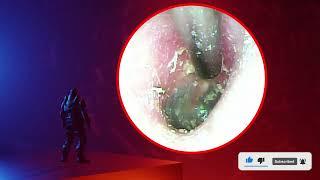 The Truth About earwax Will Shock You. How to remove earwax from ear earwax extractions