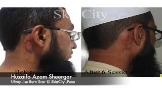 Burn keloid Scar Treatment in Pune with laser  SkinCity I India I Pune I Mumbai I Solapur