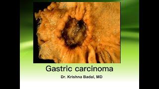 Carcinoma of stomach