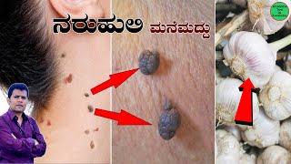 Naroli Mane Maddu  Naruli Removal in Kannada  Skin Tags Removal Home Remedies Kannada #Shorts