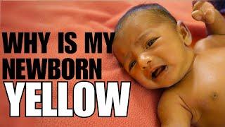 Newborn Jaundice Causes Symptoms and Treatment