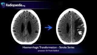 Stroke Haemorrhagic transformation - radiology video tutorial CT MRI