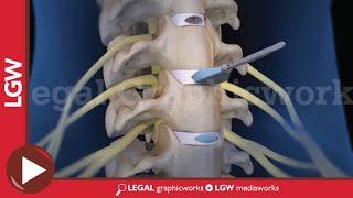 Cervical Discectomy & Fusion Surgery 3D animation C3 C4 C5 C6