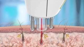 Rio Laser Tweezer Animation