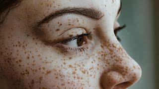 Freckles  Age-spots  LaserTreatment