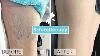 Sclerotherapy Leg Vein Treatment  The Laser and Skin Clinic