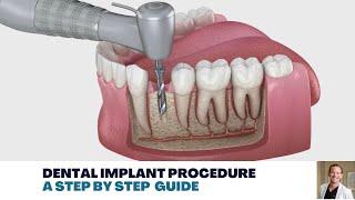 Dental Implant Procedure A Step by Step Guide