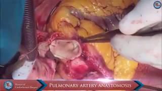 Standard orthotopic heart transplantation