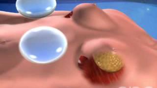 Breast Implant Surgery - 3D Medical Animation  ABP ©