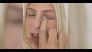 Eyelid lift review - Karens upper blepharoplasty at Cosmedics London