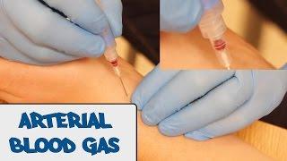 Arterial Blood Gas Sampling ABG - OSCE Guide old version  UKMLA  CPSA