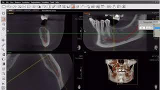 Этап имплантации зубов компьютерная томография кт
