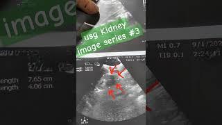 usg kidney image series #3