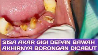 Gara Gara Sisa Akar Gigi Bawah Depan Yang Menonjol Sering SakitLebih Baik Dicabut Saja Keduanya