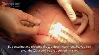 Zip use in C-sections