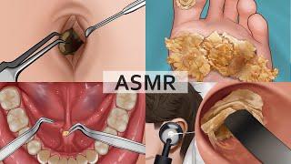ASMR Collection 2 Remove Large Plantar Warts Huge Navel Stone Salivary Gland Stones Ear Cleaning