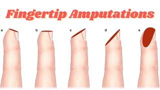 Fingertip Amputations And How To Treat Them