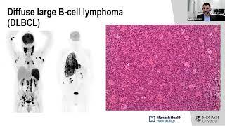 Relapsed  Refractory Diffuse Large B-Cell Lymphoma DLBCL with Dr Gareth Gregory