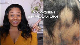 Why you have bald spots Anagen Effluvium Explained Excessive Shedding & balding 101 @IamCynDoll