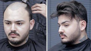 PROTEZ SAÇ İLE DEĞİŞİN - Hair Replacement