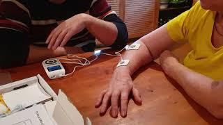Китайский миостимулятор в реабилитации руки после инсульта.