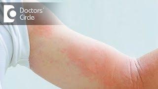 What causes Cold Hives & how to manage it? - Dr. Urmila Nischal