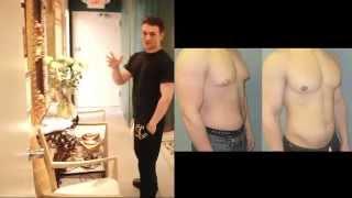 Adolescent Gynecomastia with Dr. Blau - JOSES STORY