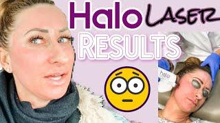Halo Laser Recovery Before & After Final Thoughts Over 40 Combination Skin