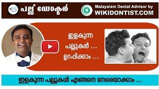 ഇളകുന്ന പല്ലുകൾ എങ്ങനെ നേരെയാക്കാം.. മലയാളം Mobile loose teeth Dental VideosDr.Thomas Nechupadam