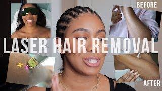 Laser Hair Removal Things To Know + Before & After  zoerudd