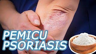 Pemicu Psoriasis yang Haru Diketahui