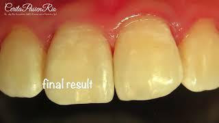 Midline anterior teeth caries restoration penambalan gigi depan